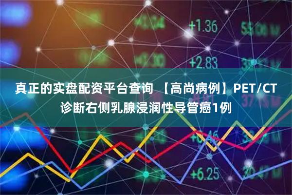 真正的实盘配资平台查询 【高尚病例】PET/CT诊断右侧乳腺浸润性导管癌1例